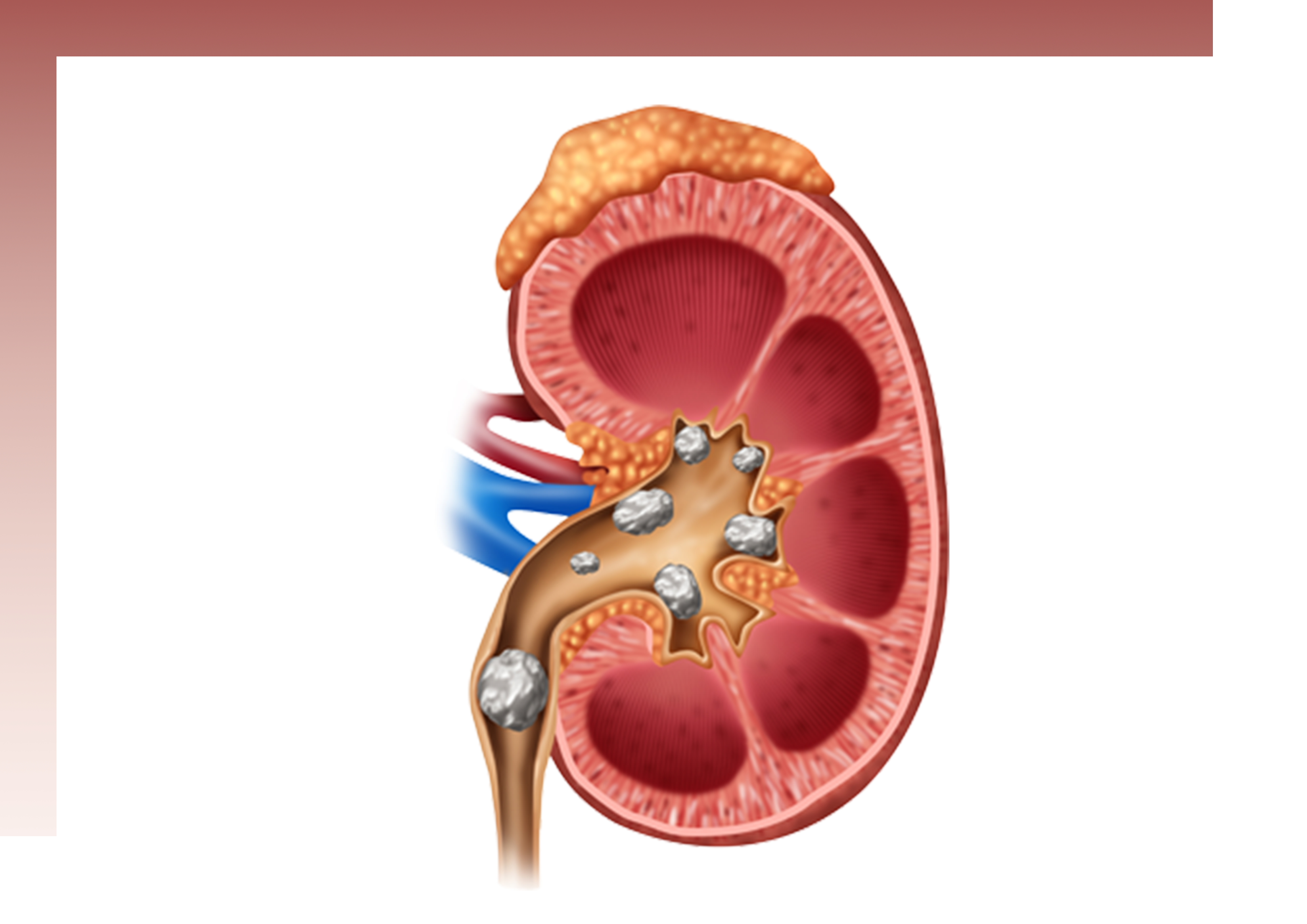 Painless Kidney Stone Treatment at AINU