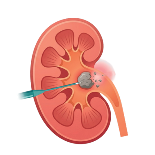 Kidney stone treatment illustration